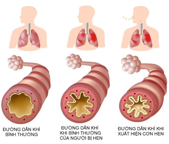 Khi nào áp dụng Đông y điều trị và dự phòng hen phế quản? - Ảnh 1. Khi nào áp dụng Đông y điều trị và dự phòng hen phế quản? - Ảnh 1.