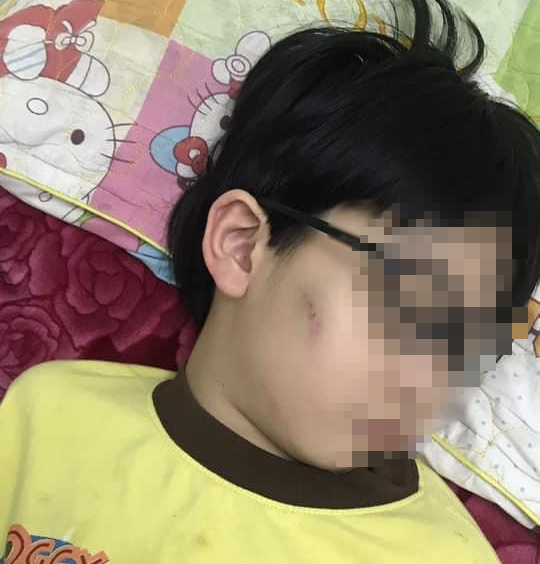 Quảng Ninh: Bé trai 8 tuổi bị bố mẹ đánh dã man vì chưa làm bài tập  - Ảnh 2.