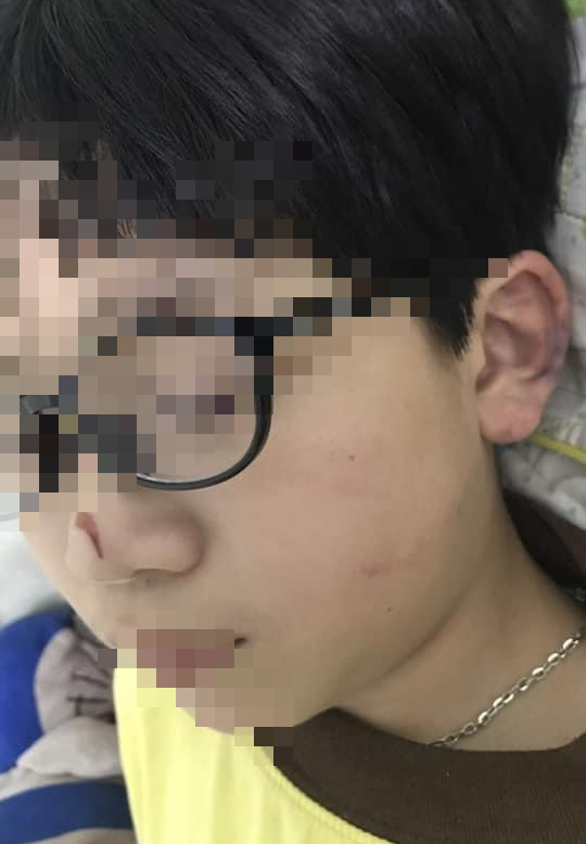 Quảng Ninh: Bé trai 8 tuổi bị bố mẹ đánh dã man vì chưa làm bài tập  - Ảnh 3.
