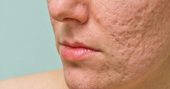 Cách chăm sóc và điều trị sẹo rỗ