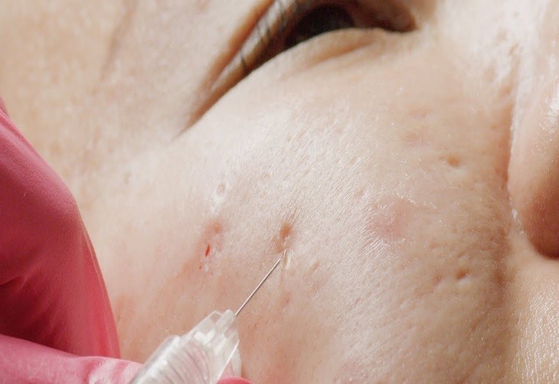 Cách chăm sóc và điều trị sẹo rỗ Cách chăm sóc và điều trị sẹo rỗ