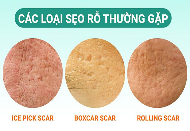 Cách chăm sóc và điều trị sẹo rỗ Cách chăm sóc và điều trị sẹo rỗ