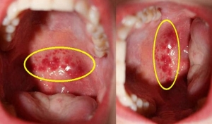 Viêm họng mạn tính là gì? Dấu hiệu và cách phòng ngừa, điều trị