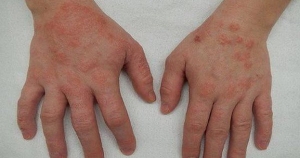 Vì sao viêm da cơ địa dễ tái phát vào mùa lạnh?