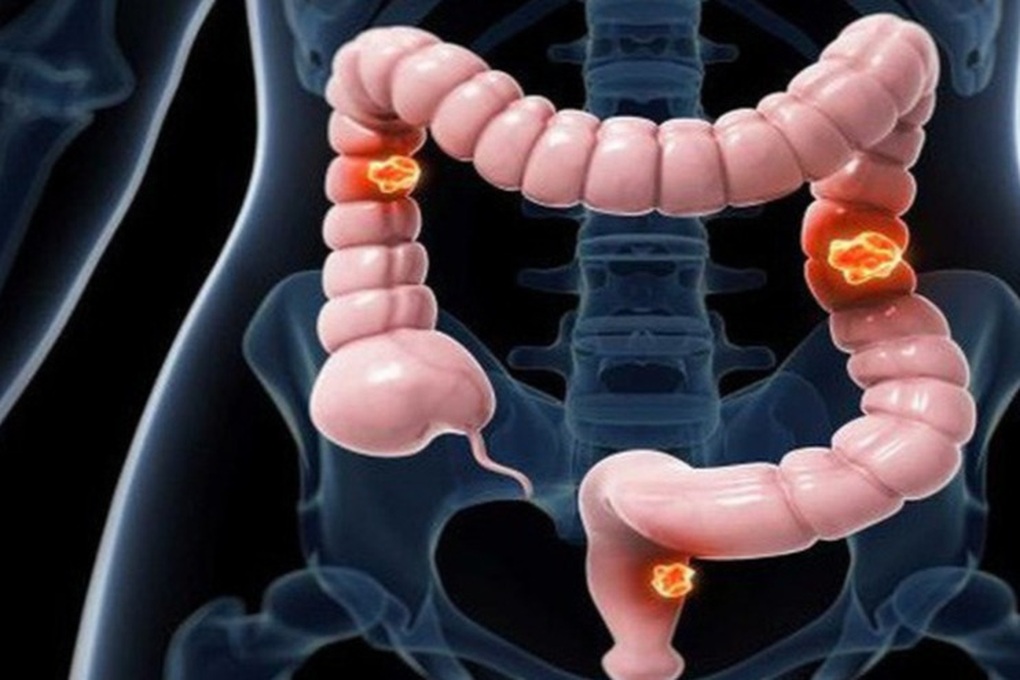 Để phòng chống ung thư đại trực tràng, bạn phải biết điều này Để phòng chống ung thư đại trực tràng, bạn phải biết điều này