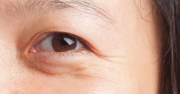 Da dưới mắt chảy xệ khắc phục thế nào?