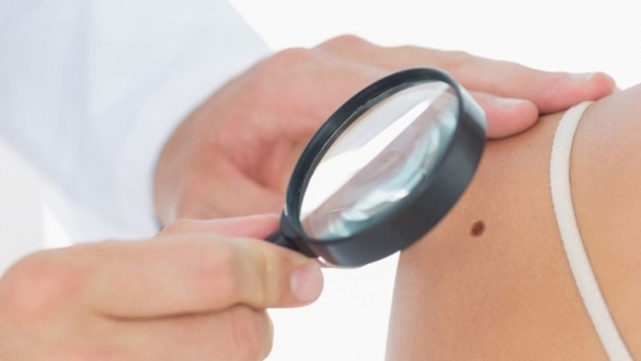 4 dấu hiệu cảnh báo nốt ruồi chuyển thành ung thư