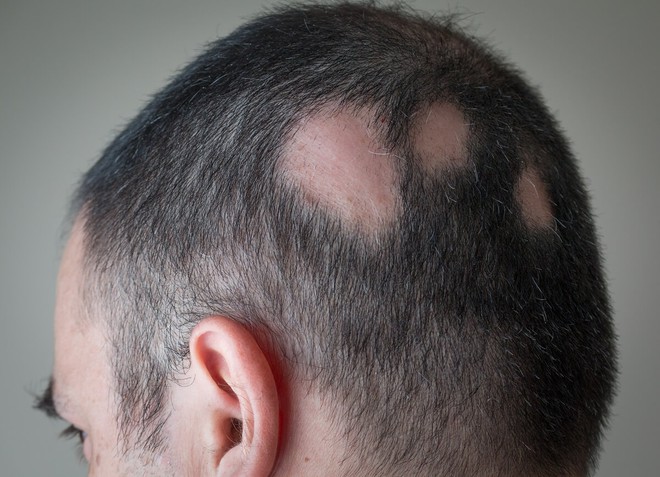 Thói quen thường gặp sau khi gội đầu lại là nguồn cơn khiến tóc gãy rụng, nấm bám trên da đầu - 2